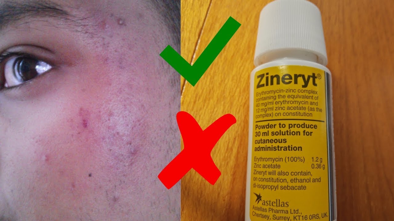 zineryt-tratament-acnee